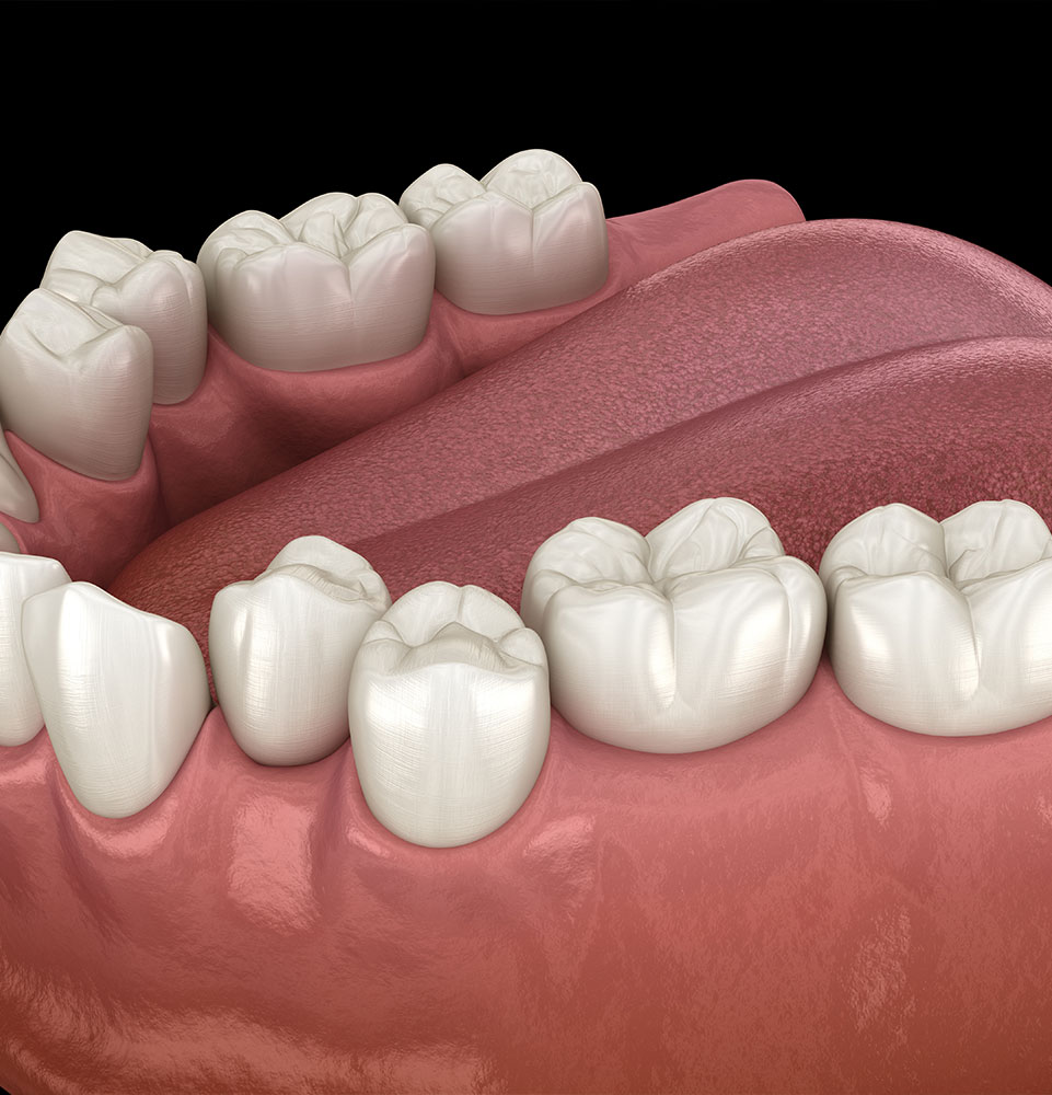 misaligned teeth