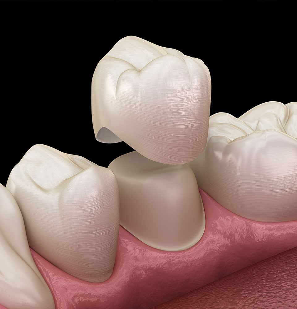 Dental crown