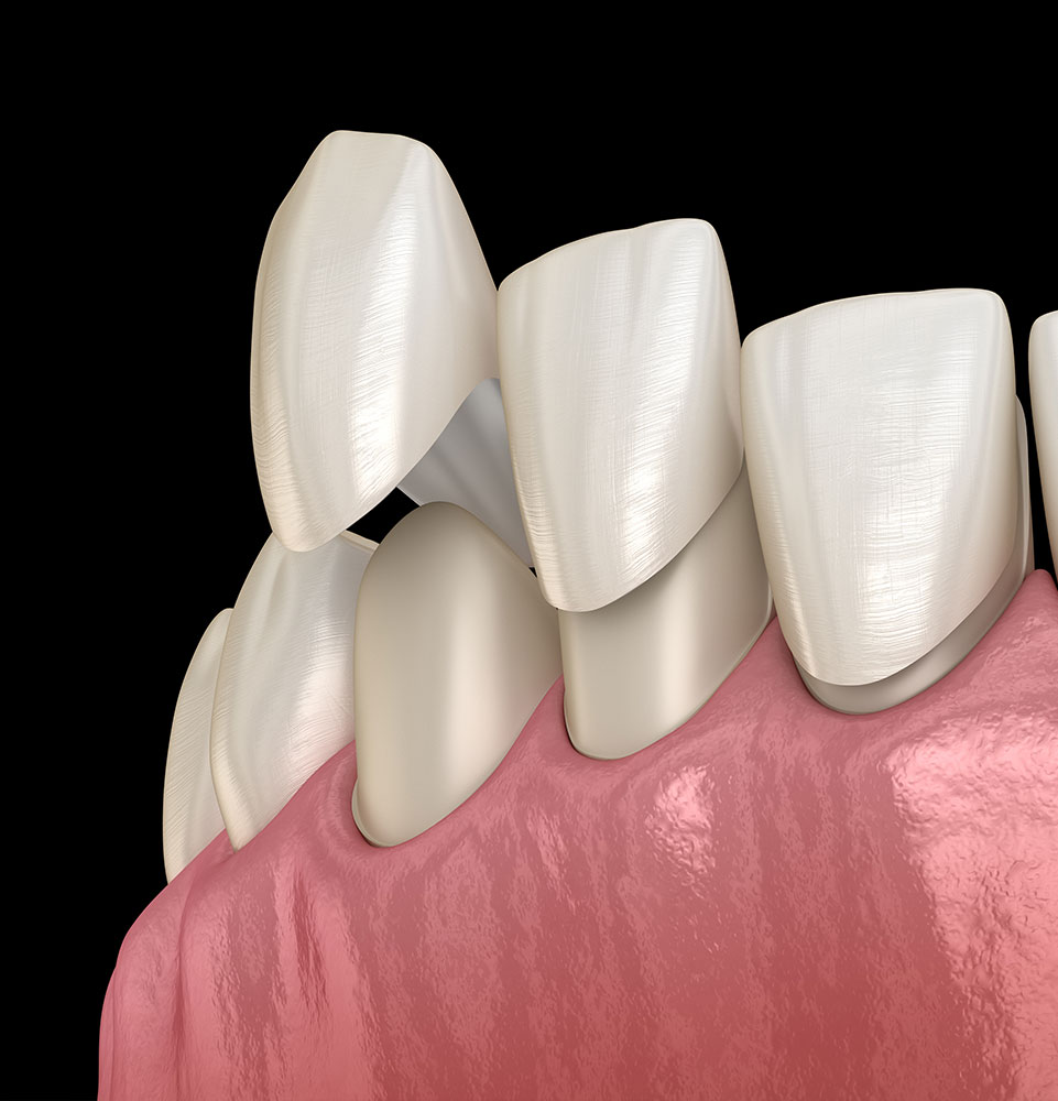 veneers