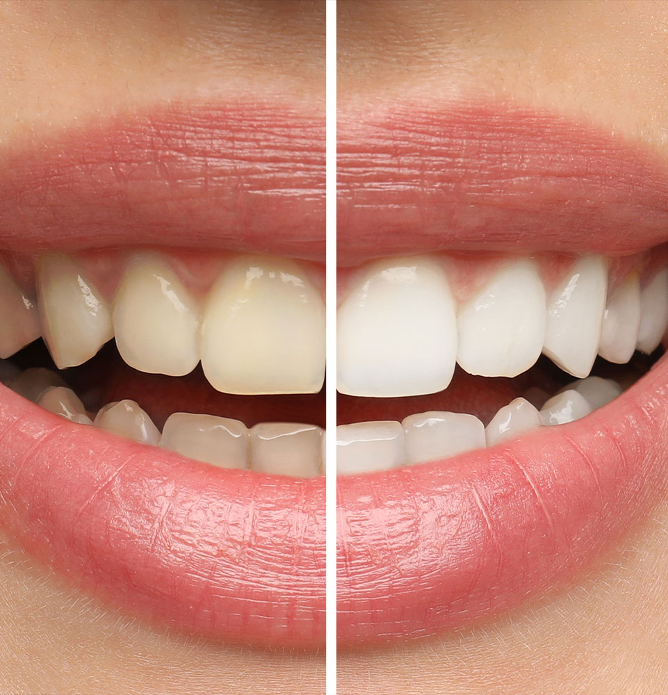 Teeth whitening