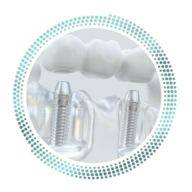 dental bridge
