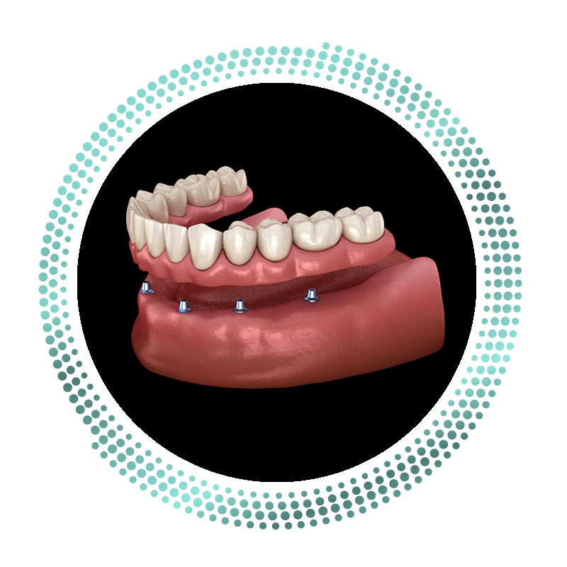 implant support dentures
