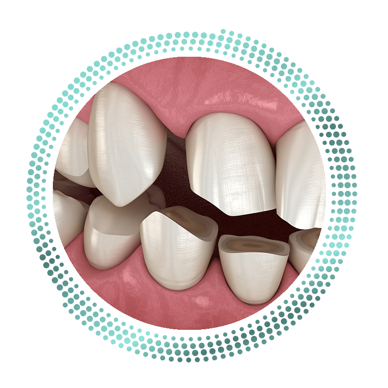 bruxism
