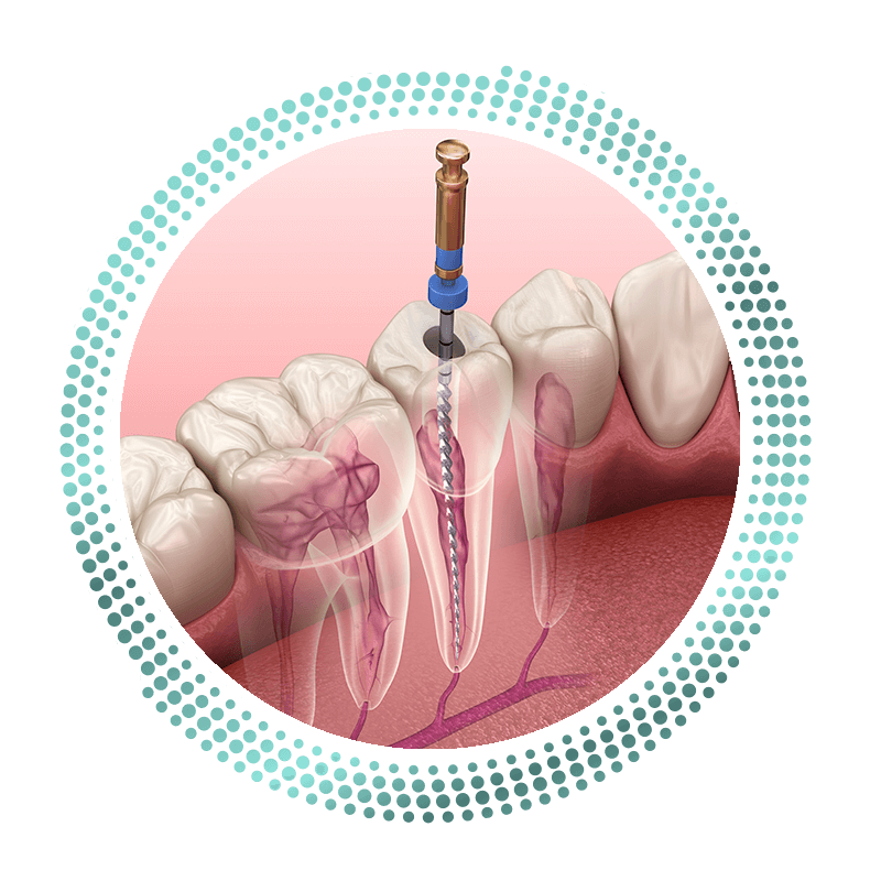 Root canal
