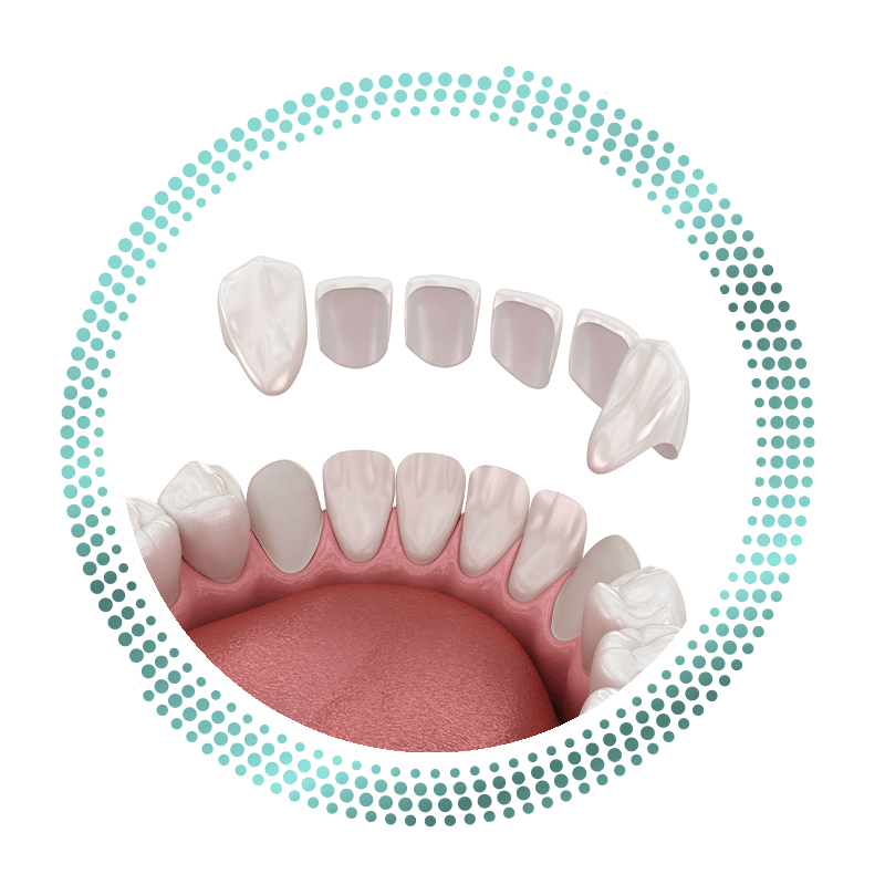 veneers