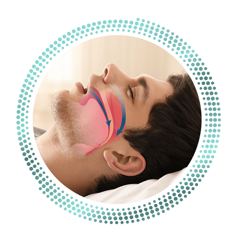 sleep apnea